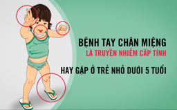 Hình ảnh chi tiết tin tức Bệnh Tay Chân Miệng là truyền nhiễm cấp tính Hình ảnh tin tức Bệnh Tay Chân Miệng là truyền nhiễm cấp tính